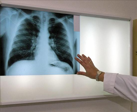 El TSJC condemna a ROCA SA a indemnitzar la vídua d'un treballador mort per Silicosi